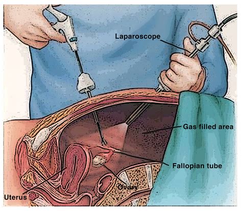 cirurgia de endometriose